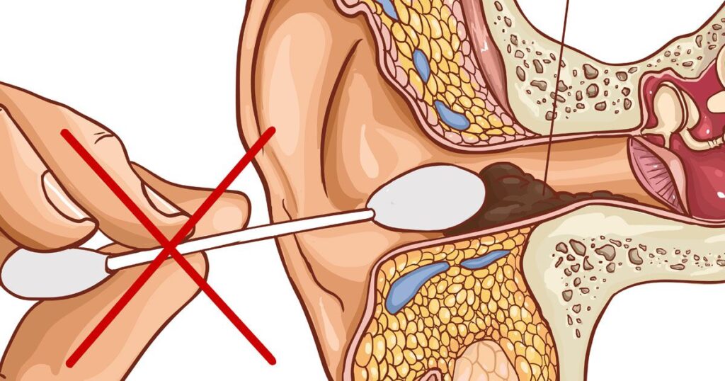 Methods of Ear Wax Removal