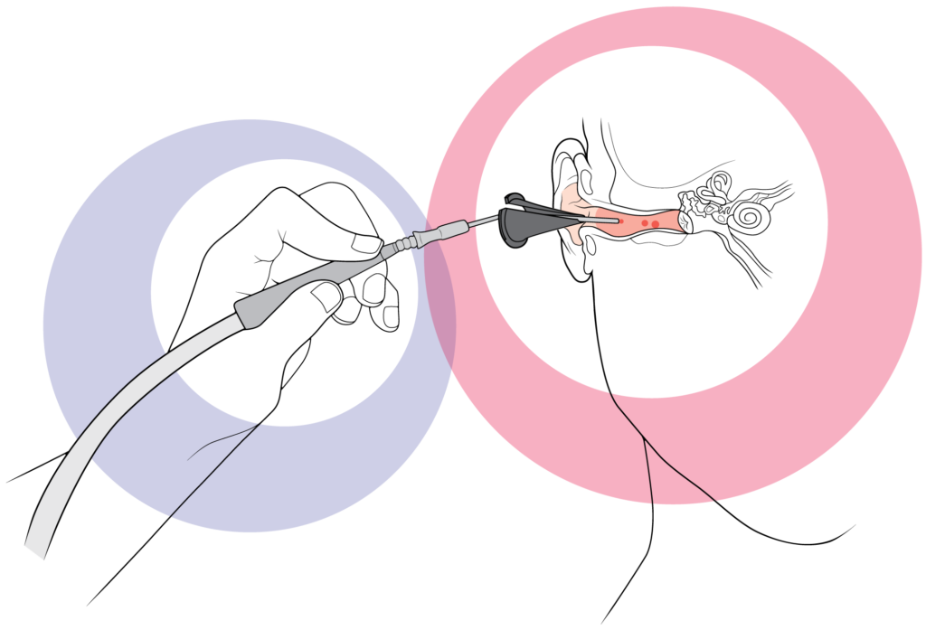 Microsuction Work